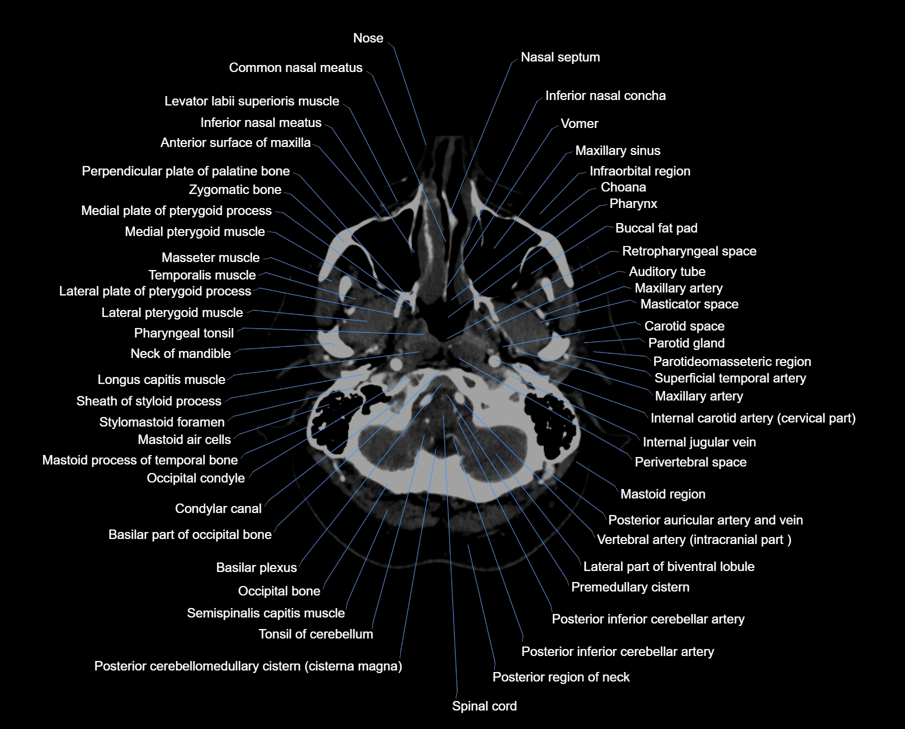 CT scan brain axial labelled cross sectional anatomy image-img-00005.webp